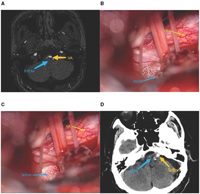 The effect of microvascular decompression of the CN IX-X root entry/exit zone and the ventrolateral medulla in neurogenic hypertension involving the vertebral/basilar artery